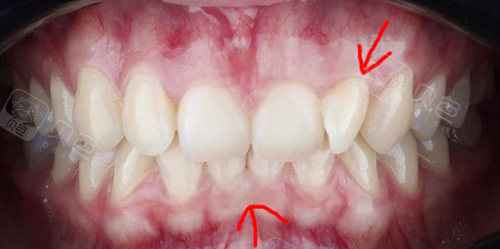 牙齿内扣有必要矫正吗?只要是影响咬合关系还是要矫正!