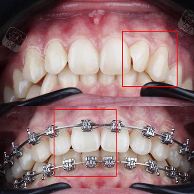 牙齿内扣有必要矫正吗?只要是影响咬合关系还是要矫正!