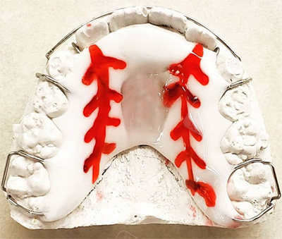 平导矫正器是什么?在正畸中起到什么作用?带你深入了解!