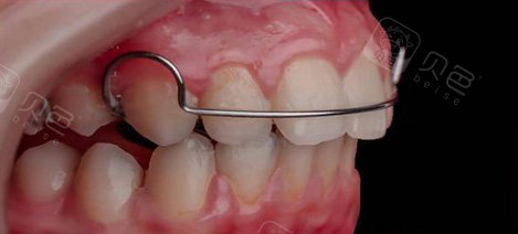 平导矫正器是什么?在正畸中起到什么作用?带你深入了解!