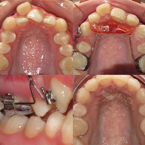 平导矫正器是什么?在正畸中起到什么作用?带你深入了解!