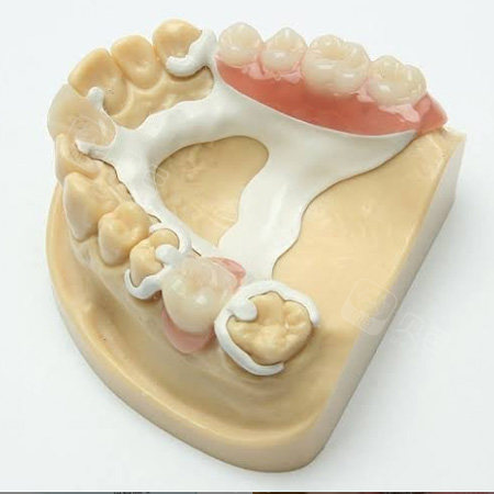 活动义齿和种植牙哪个好?为什么有人说千万不要戴活动假牙?