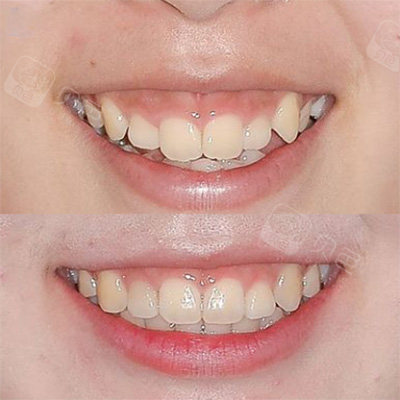 有一种尴尬是一笑就露牙龈!露龈笑怎么矫正更有效?