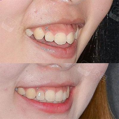 有一种尴尬是一笑就露牙龈!露龈笑怎么矫正更有效? - 贝色口腔