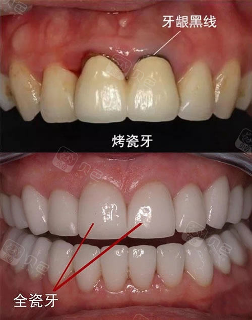 全瓷牙与烤瓷牙的区别