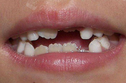 烟台德韩口腔分析儿童牙齿为什么不整齐 多大年龄矫正合适