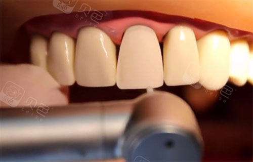牙科医生二把刀,填补的粘连剂不足,粘连不牢固造成牙冠和基牙有缝隙