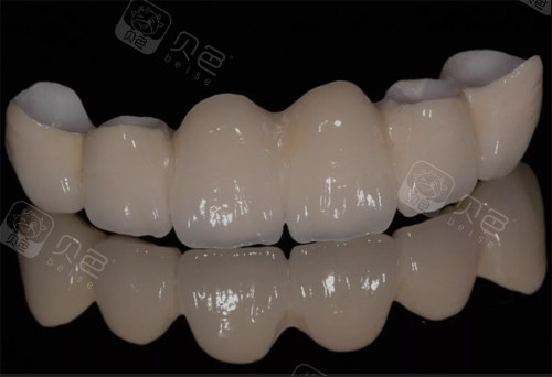 全瓷牙1200和2000的区别究竟有哪些