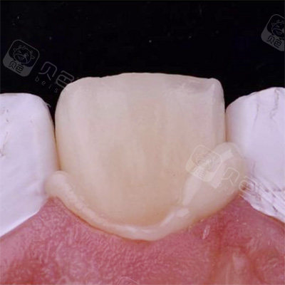 全瓷牙能用一辈子吗?是否需要定期更换?