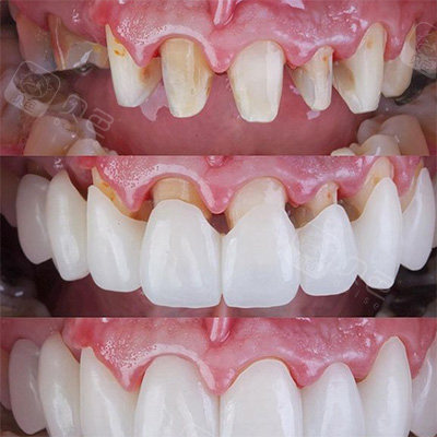 全瓷牙冠桥修复前后对比