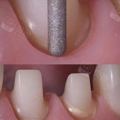 进行打磨后的基牙