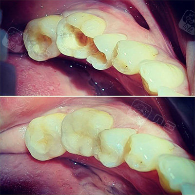 补牙和做嵌体哪个好?看看专业医生如何解答!