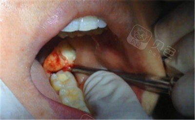 我花费1000元拔牙是不是被宰了!