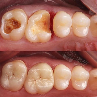 补牙前后对比