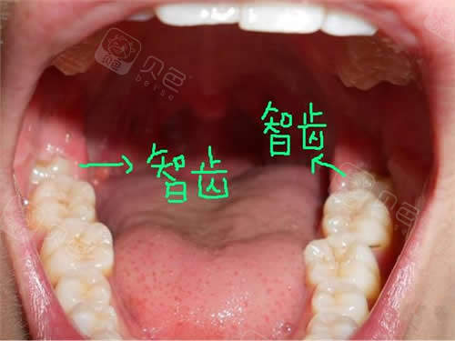 拔智齿后脸型慢慢变了,四颗智齿全拔真会瘦脸!