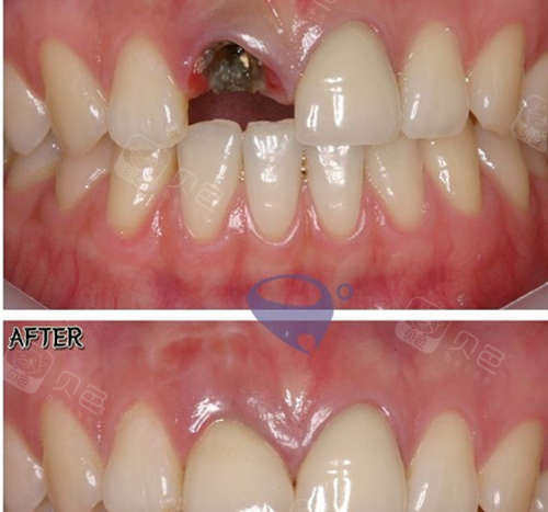 种植牙松动是什么原因如何避免种植牙松动这几点必看