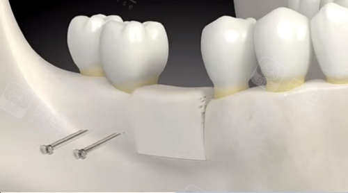 种植牙人工骨植入