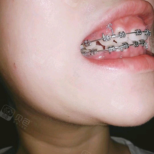 骨钉是在正畸时哪个阶段进行 打骨钉矫正是不是比较快 贝色口腔