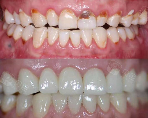 牙齿修复前后对比照片
