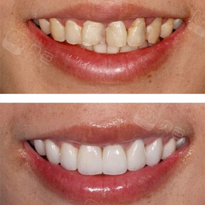 瓷贴面牙齿多少钱一颗 有哪几种材料比较好 一般能维持多久