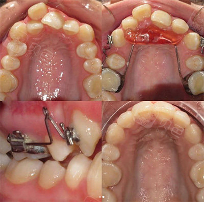 nance弓要戴多久? - 贝色口腔