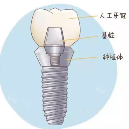 五 什么叫植骨把种植牙想象成种花,是不是土壤越好花长的越好.