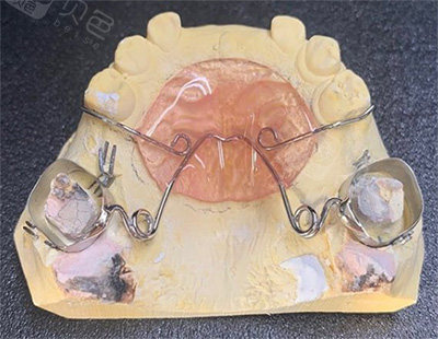 nance弓要戴多久?