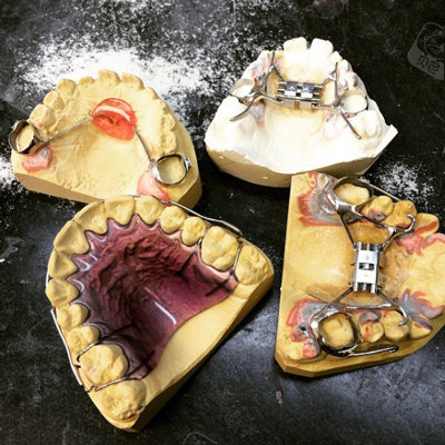 nance弓要戴多久?