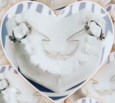 nance弓要戴多久?