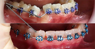 过来人告诉你,埋伏牙开窗牵引真的痛苦吗?