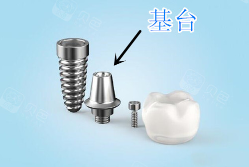 过来人解惑种植牙安装基台太疼了是真是假
