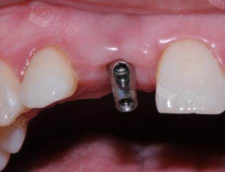 种植牙成功标准详解