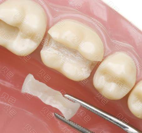 嵌体补牙