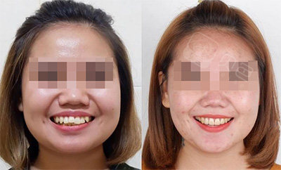 牙齿矫正后脸型变瘦