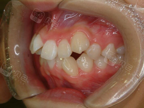 龅牙矫正术前照片