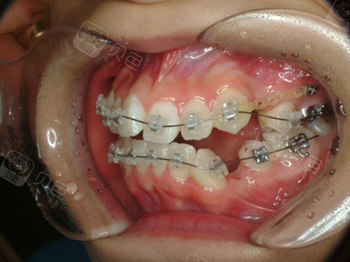 龅牙矫正术中效果