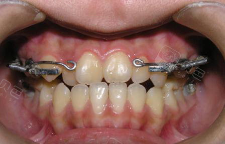 上述三种矫正方法可单独使用,也可根据牙齿的具体情况,相互配合使用