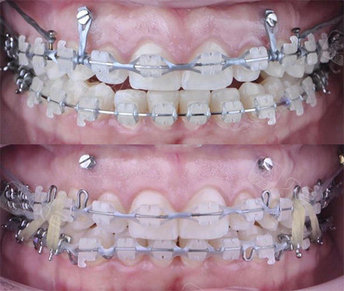 支抗钉可以改善露龈笑是真的吗?看我矫正效果就知道了!