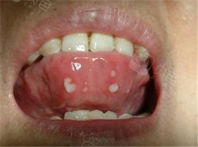 重庆口腔溃疡好的3家医院公布不排队技术好价格亲民