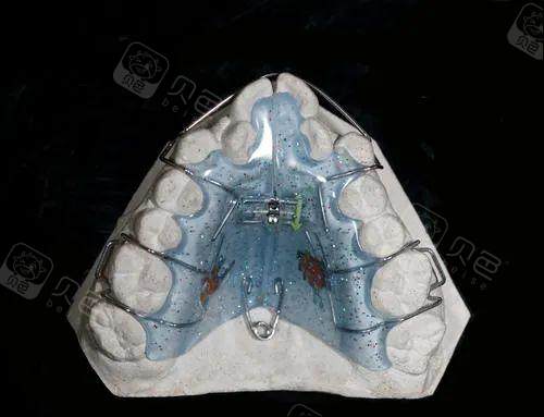 整牙为什么要扩牙弓?网上扩弓整牙失败的案例图把我劝退!