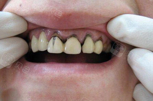 做了烤瓷牙我不想活了,烤瓷牙套里面牙烂光了!