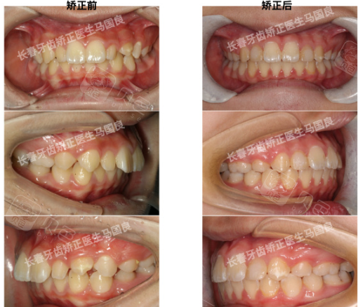长春博菲特马国良医生隐形矫正案例分享