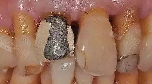 听说烤瓷牙拆除很痛苦,烤瓷牙崩瓷露出金属如何修复?