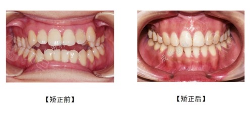 牙齿矫正选对牙医很重要,送你一份深圳口碑正畸医生名单