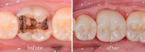 补牙前后对比案例