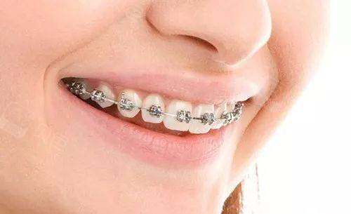 门牙前凸显嘴凸矫正要多久?矫正需要多少钱?