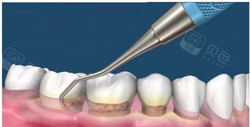 牙周刮治对牙齿有伤害吗?牙周刮治是什么意思?