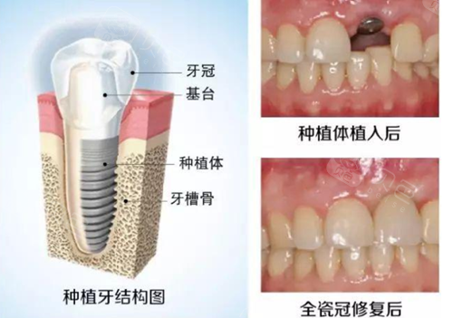 种植牙需要达到的基本条件结构展示图