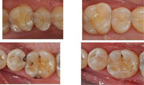 补牙前后对比照