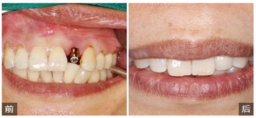 深圳拜尔口腔门牙种植牙前后对比照